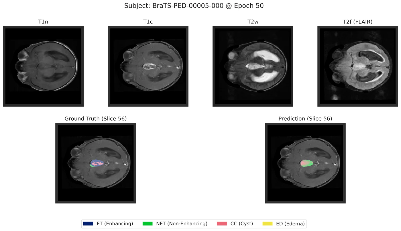 Segmentation prediction on a paediatric case